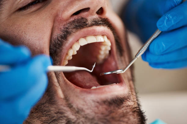 Best Emergency Dentist for Lost Fillings or Crowns in Greeneville, TN